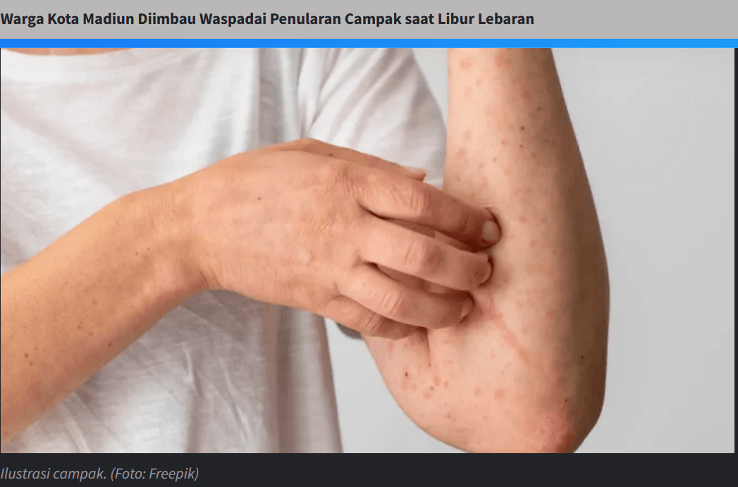 Warga Kota Madiun Diimbau Waspadai Penularan Campak saat Libur Lebaran